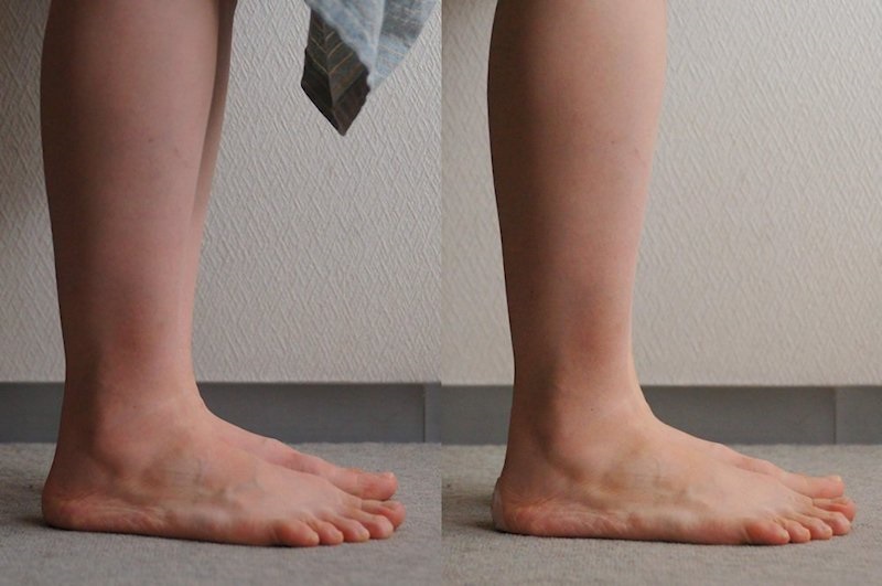 左軸足・右利き足の方の場合、利き足側から見たかかとの肉の側面の変化